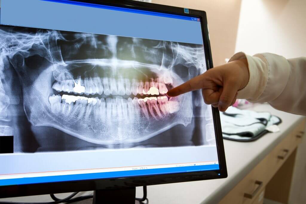 Why Do I Need Dental XRays? Alpine Dental Center